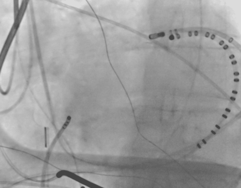 Image 4 - Fluoro of ablation at the proximal anterior interventricular vein.